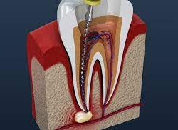 root canals